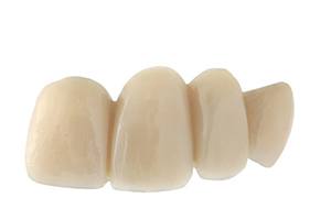 four tooth dental bridge