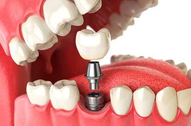 three D illustration showing how dental implants work