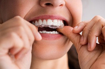 a person putting a nightguard over their teeth