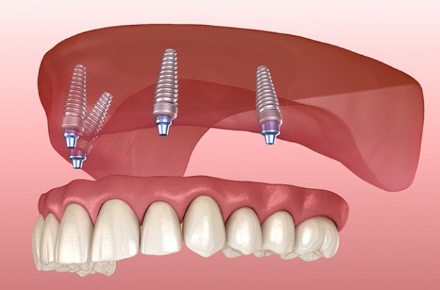 Dentures for upper arch being attached to All-on-4 in East Longmeadow & Northampton
