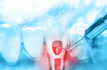 Illustration of tooth receiving root canal therapy in East Longmeadow & Northampton 