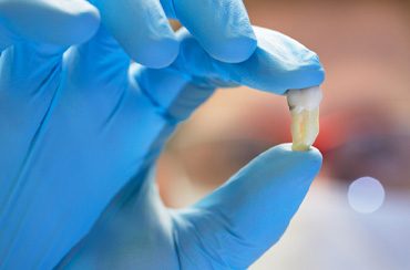 Dentist holding up tooth after an extraction 