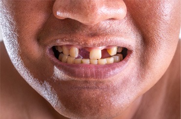 A close-up of a young man with missing teeth