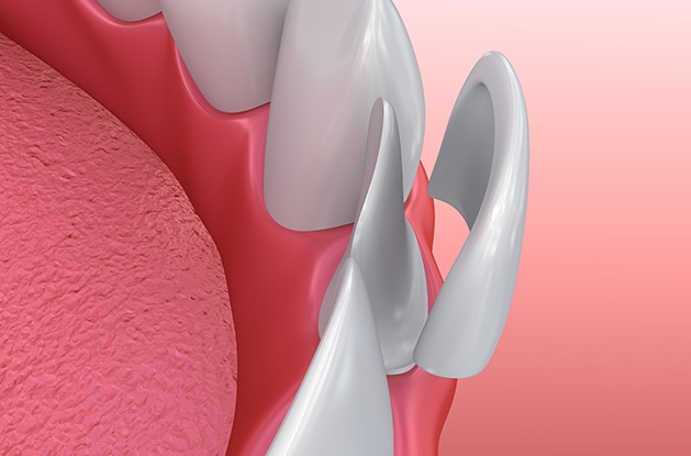 illustration of veneers