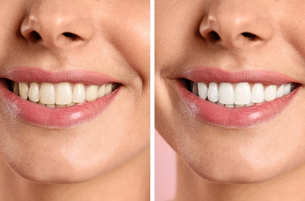 smile before and after teeth whitening