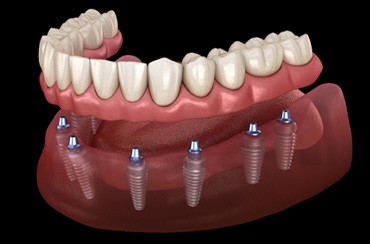 A 3D illustration of all-on-4 dentures