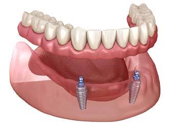 Diagram of an implant denture in East Longmeadow and Northampton