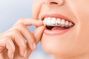 woman putting teeth in invisalign tray