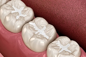 three tooth colored fillings