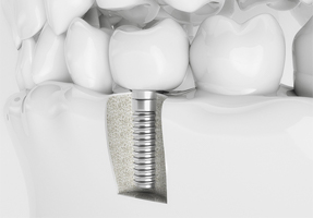 implants in jaw bone