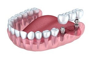 denture retained by implant