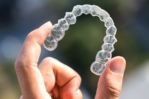 clear aligner