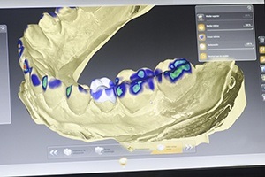 soft tissue laser impression