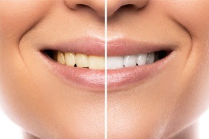 side by side teeth whitening