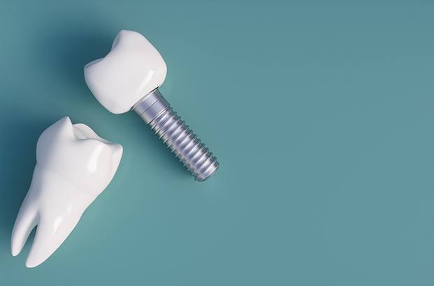 dental implants against a green background