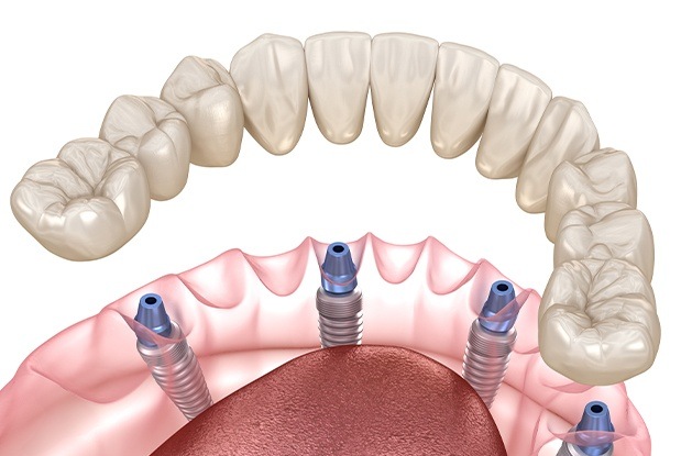 illustration of implant denture