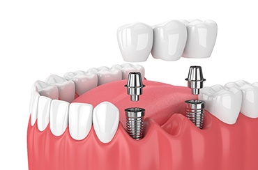 Diagram of an implant bridge in East Longmeadow and Northampton