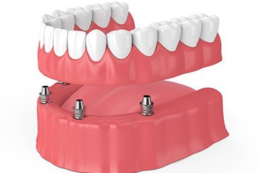 Diagram of an implant denture in East Longmeadow and Northampton