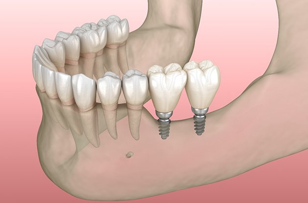 Diagram showing mini dental implants in East Longmeadow and Northampton