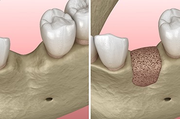 Diagram showing before and after bone grafting in East Longmeadow