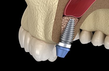 Diagram of dental implant after sinus lift in Northampton