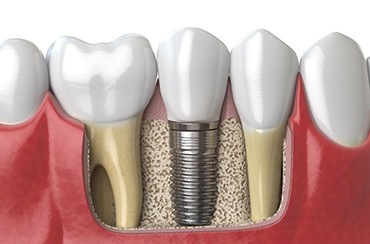 Diagram of dental implants after placement