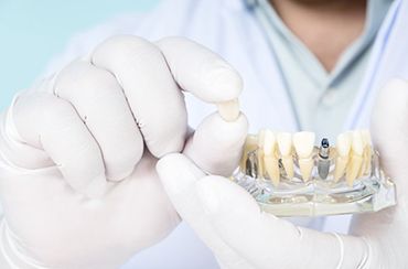 dental restoration and model jaw
