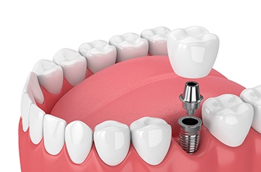 Diagram of single dental implant in East Longmeadow and Northampton