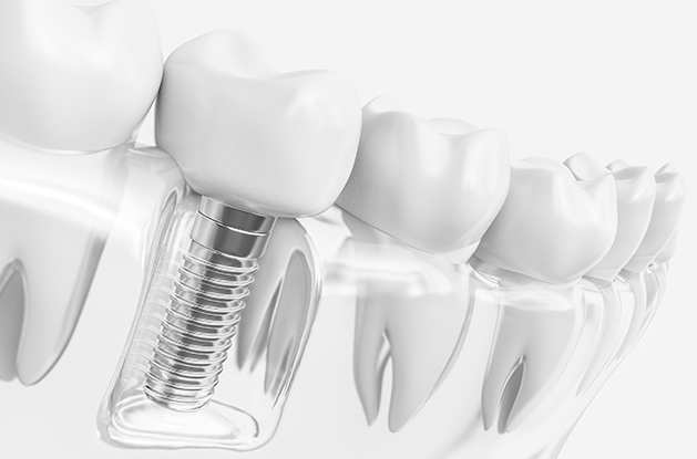 dental implant restorations mockup