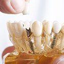 Model of implant supported dental crown