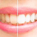 Closeup of teeth half before and half after teeth whitening