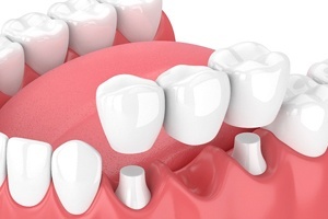 dental bridge white mock up