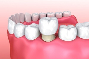 crowns on pink mock smile