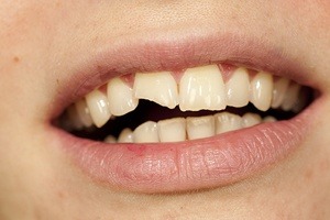 chipped tooth close up