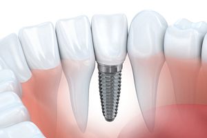 silver implant