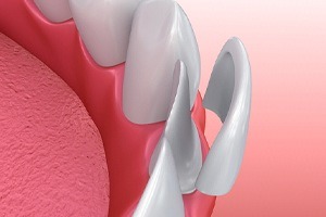 porcelain veneer on tooth