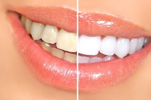 smile split before and after whitening
