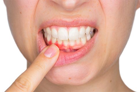Person with inflamed gums in East Longmeadow & Northampton