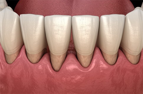 Receding gums in East Longmeadow & Northampton