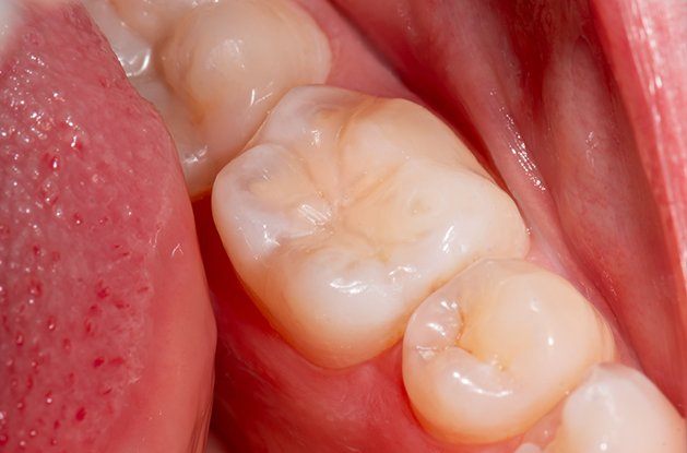 close up of dental sealant