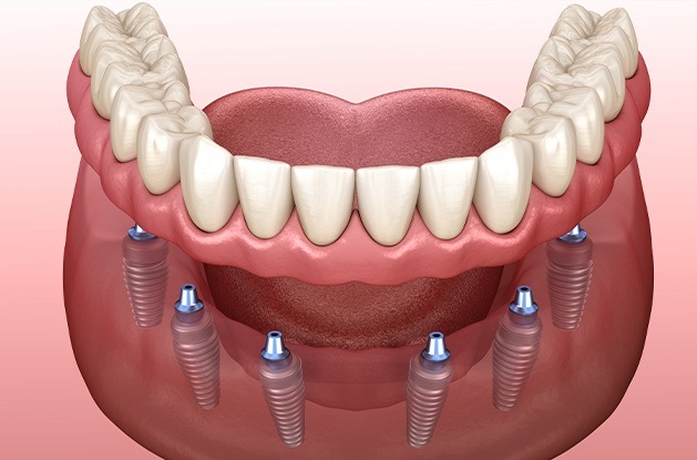 illustration of implant denture