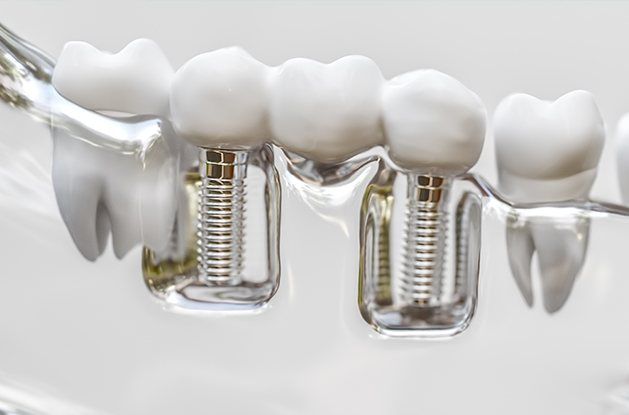 dental bridge mockup