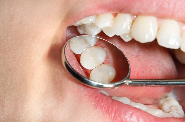 close up of tooth colored fillings