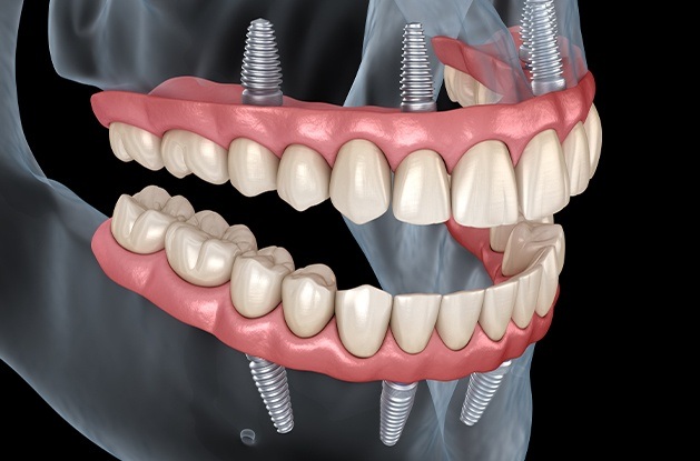 illustration of dentures