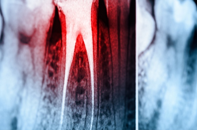 red tooth on x-rays