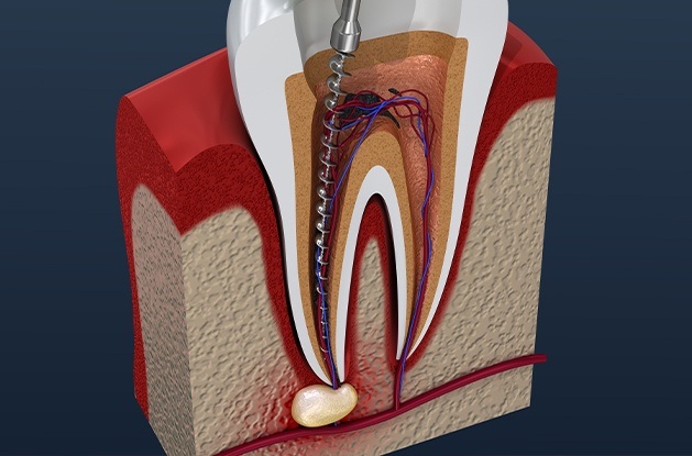 illustration of root canal