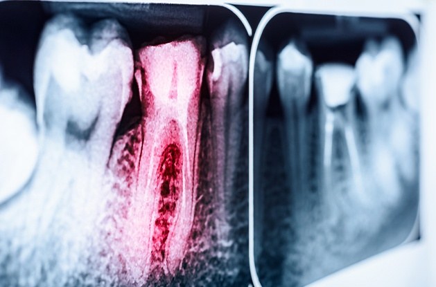 red tooth on x-ray