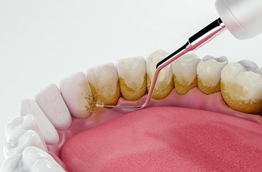 a computer illustration showing a scaler cleaning plaque from behind the teeth