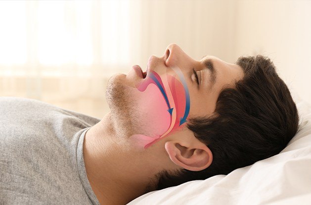man sleeping with airway arrows on face