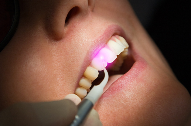 soft tissue laser in front of tooth